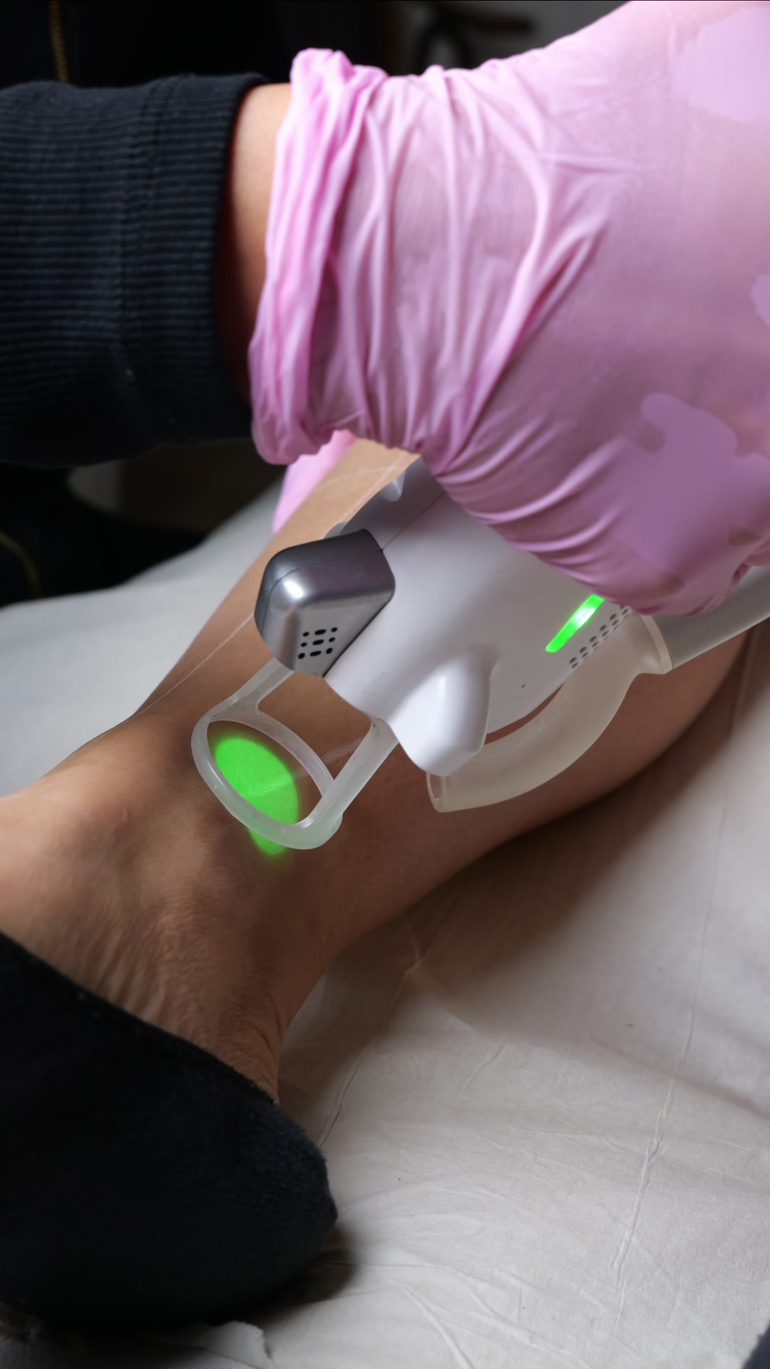 Clarity2 laser hårborttagning hos Lemoge Clinic